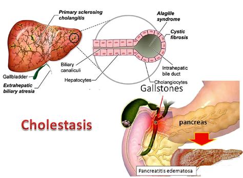 symptoms of bile leak|Cholestasis: Definition, Symptoms, Treatment, Causes